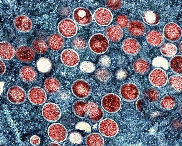 Hình ảnh: TPHCM có ca tử vong đầu tiên liên quan đến bệnh đậu mùa khỉ số 1