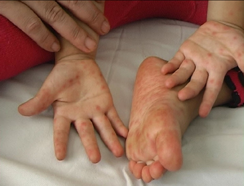 Hình ảnh: Bộ Y tế yêu cầu tăng cường phòng, chống bệnh tay chân miệng số 1
