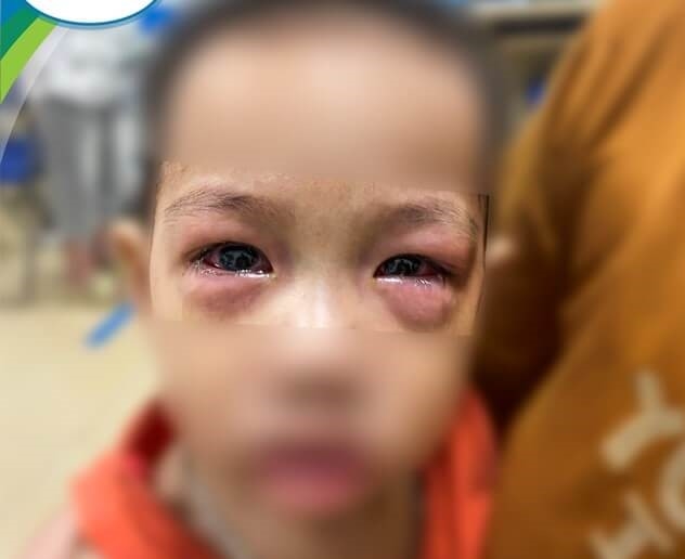 Hình ảnh: Trẻ đau mắt đỏ gia tăng, dễ lây lan thành dịch số 1