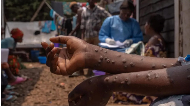 Hình ảnh: Congo nhận 100.000 liều vaccine mpox đầu tiên số 1