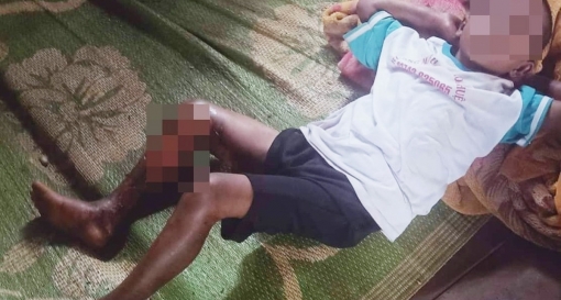 Đắk Lắk: Bé trai 8 tuổi bị đốt bỏng chân